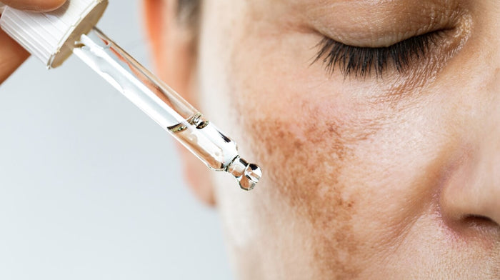A woman using serum on her facial pigmentation