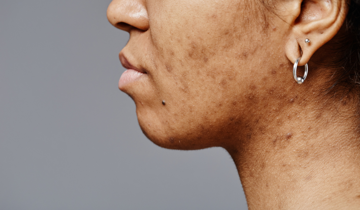 A side profile image of acne vulgaris on a woman's face